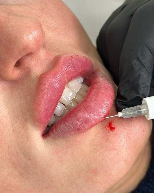 Les 5 erreurs à éviter avec les injections aux lèvres